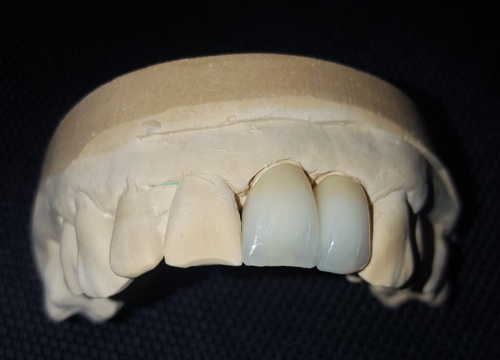 Layered IPS Emax crowns