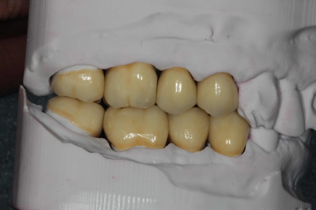 8 unit monolithic zirconia crowns on 3d printed models