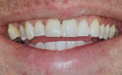 AFTER PHOTO SMILE MAAKEOVER WITH UR1 UL1 MONOLITHIC ZIRCONIA CROWNS