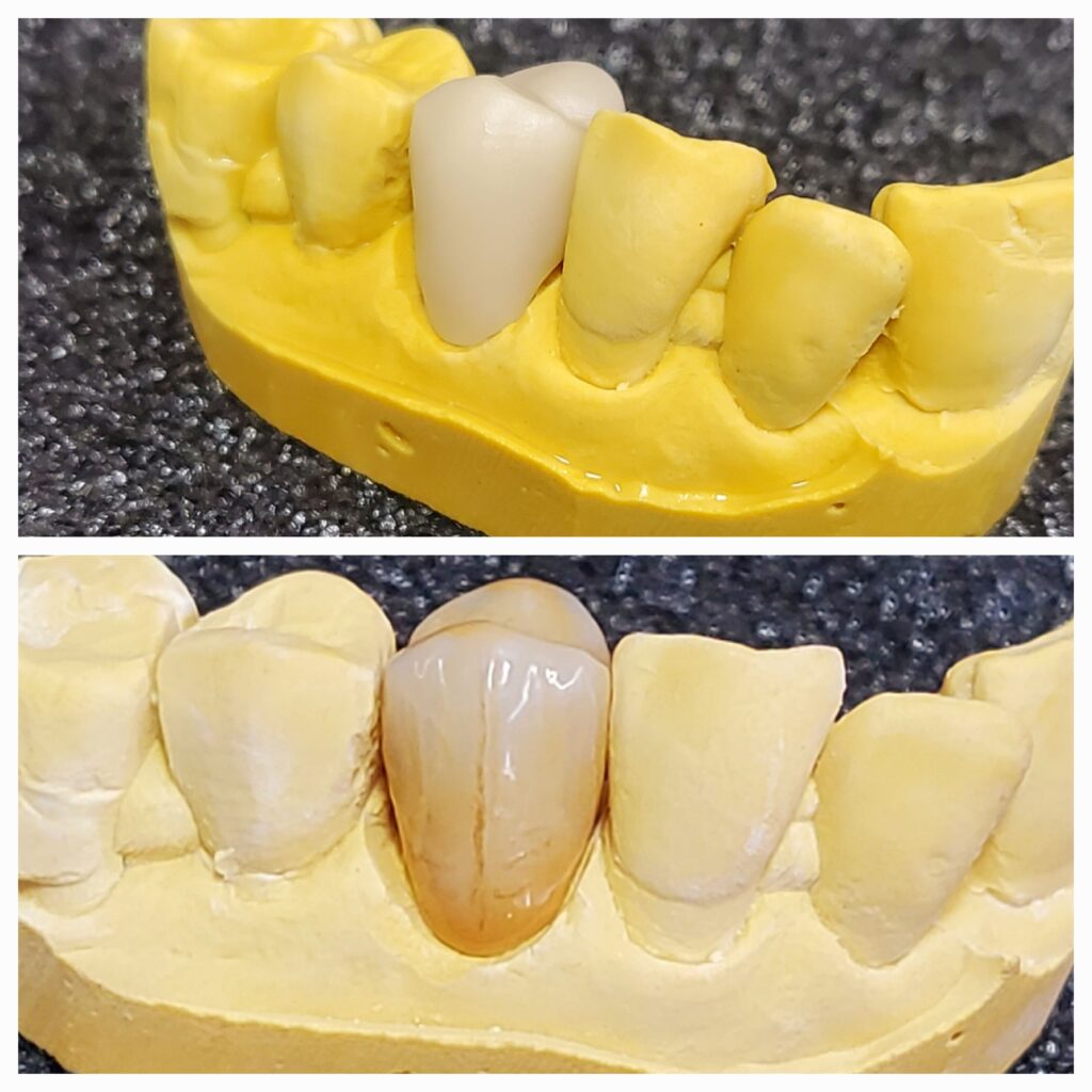 Before and after monolithic zirconia crown with MiYo liquid ceramic applied for stained effect teeth