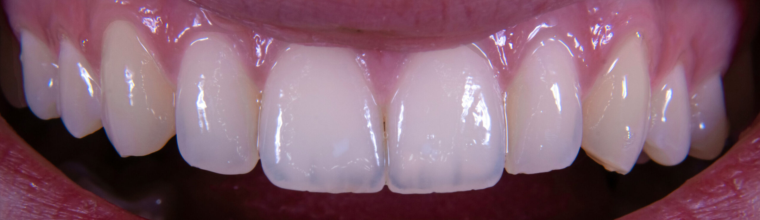 Full smile with all ceramic veneers and crowns