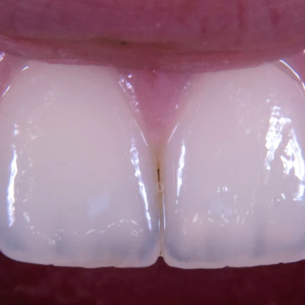 FULL SMILE Ceramic crowns and veneers